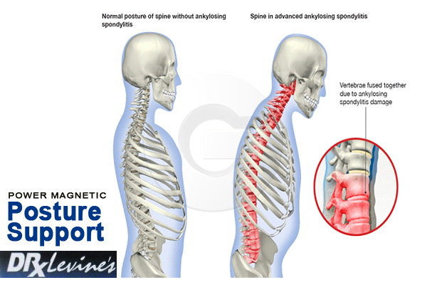 Power magnetic Posture Sport Prevent Chronic Neck and Back Pain Improve Posture!